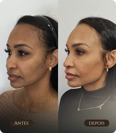 Contorno facial e olheiras