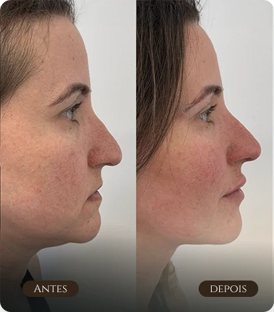Rinomodelação e mento - Perfiloplastia