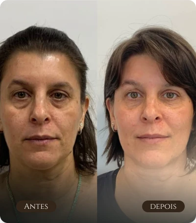 Olheiras e full face