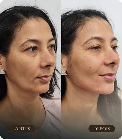 Contorno facial e olheiras