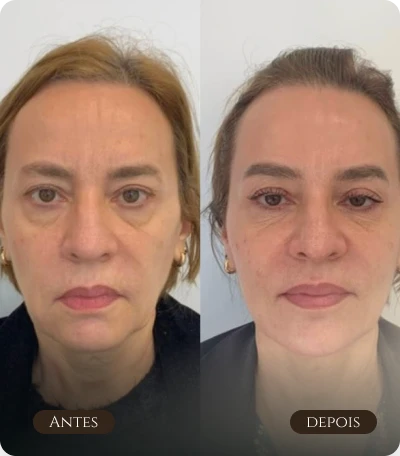 tratamento flacidez e contorno facial