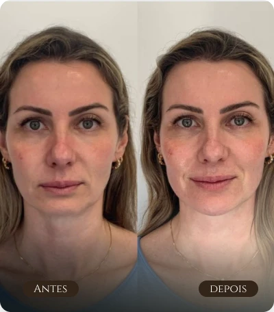 full face e melhora do contorno facial