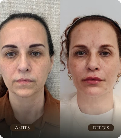 contorno facial e marionete