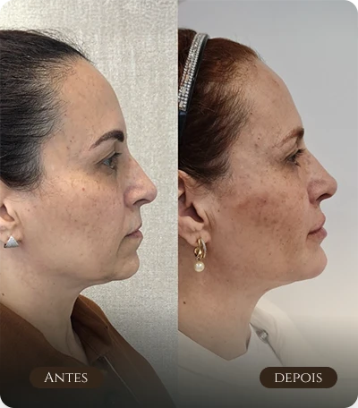 contorno facial e marionete